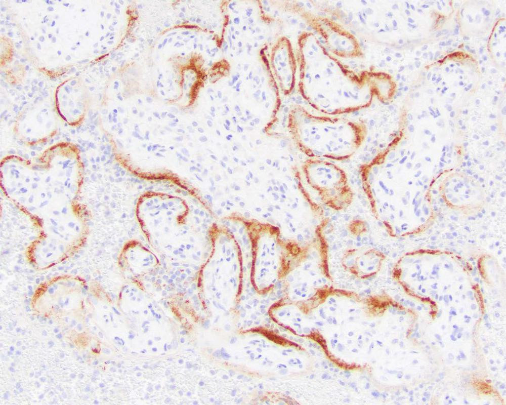 This microscope image provided by the College of American Pathologists and Archives of Pathology and Laboratory Medicine shows placental cells from a stillbirth with SARS-CoV-2 infection indi