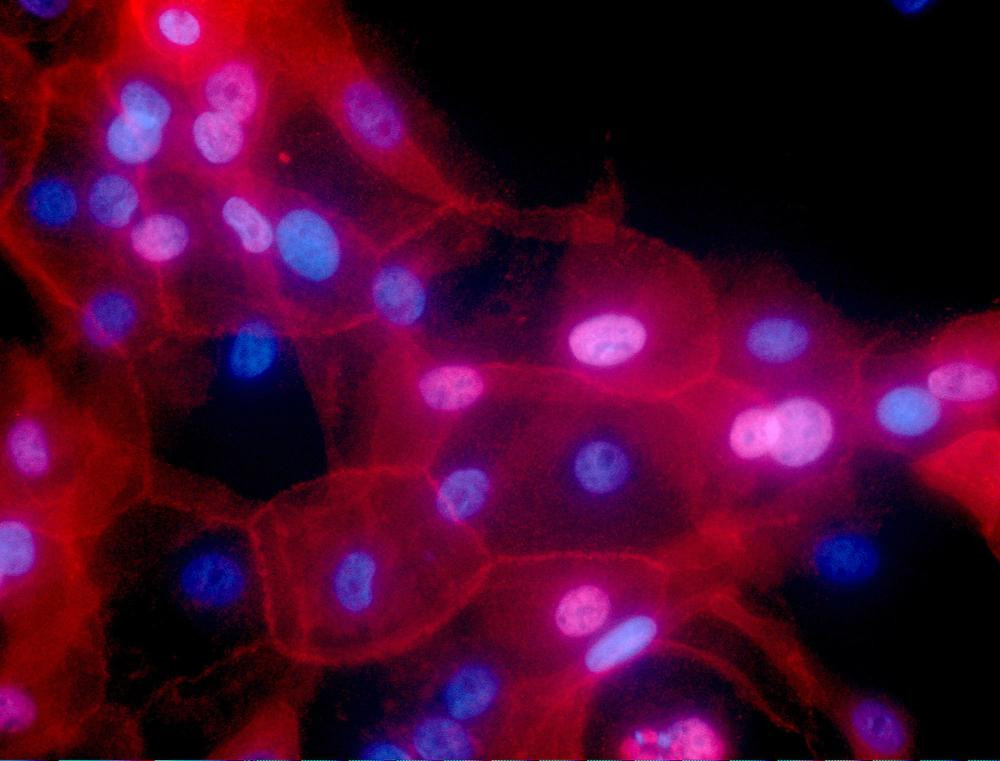 FILE - This undated fluorescence-colored microscope image made available by the National Institutes of Health in September 2016 shows a culture of human breast cancer cells.