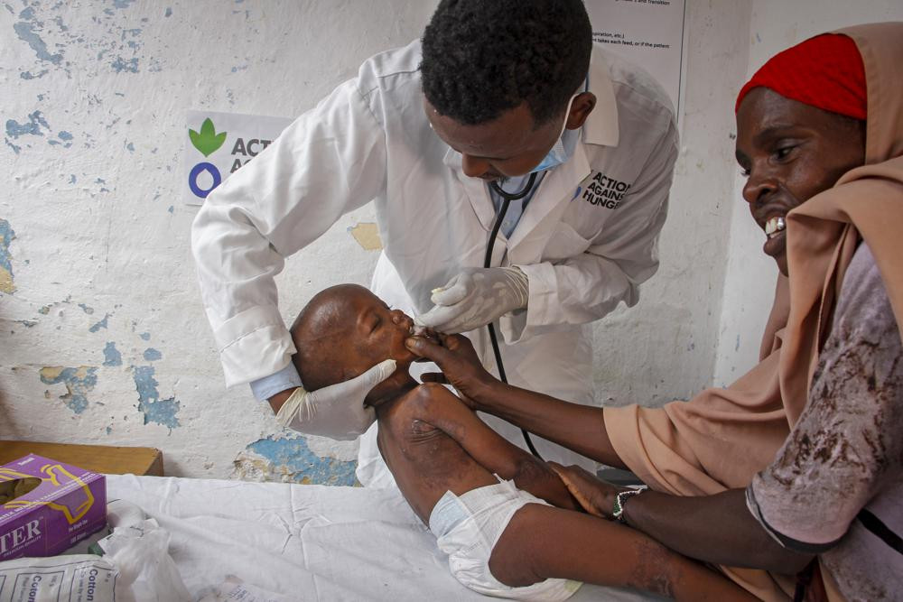 Doctor Mustaf Yusuf treats Ali Osman, 3, who is showing symptoms of Kwashiorkor as his mother Owliyo Hassan Salaad, 40, holds him at a malnutrition stabilization in Mogadishu, Somalia Sunday,