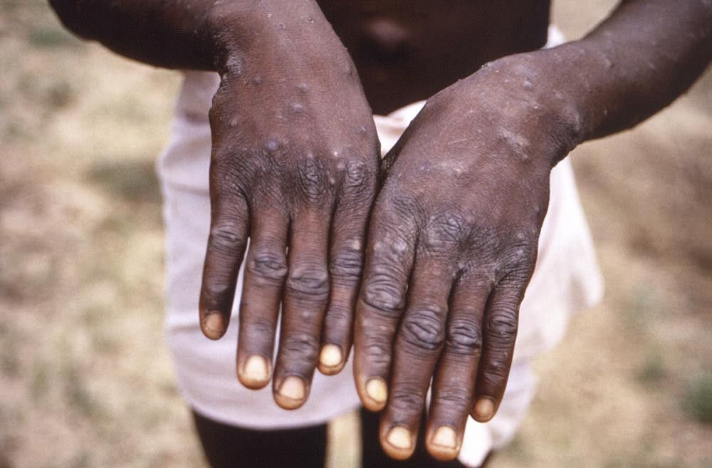 FILE - This 1997 image provided by the CDC during an investigation into an outbreak of monkeypox in the Democratic Republic of the Congo (DRC), formerly Zaire, and depicts the dorsal surfaces