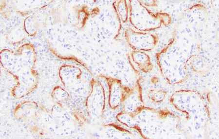 This microscope image provided by the College of American Pathologists and Archives of Pathology and Laboratory Medicine shows placental cells from a stillbirth with SARS-CoV-2 infection indi