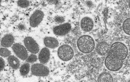 This 2003 electron microscope image made available by the Centers for Disease Control and Prevention shows mature, oval-shaped monkeypox virions, left, and spherical immature virions, right.